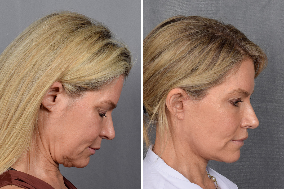 Facelift Before & After Gallery - Patient 110525 - Image 8
