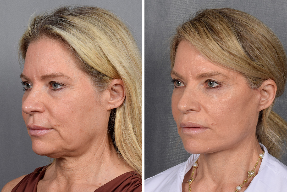 Facelift Before & After Gallery - Patient 110525 - Image 1