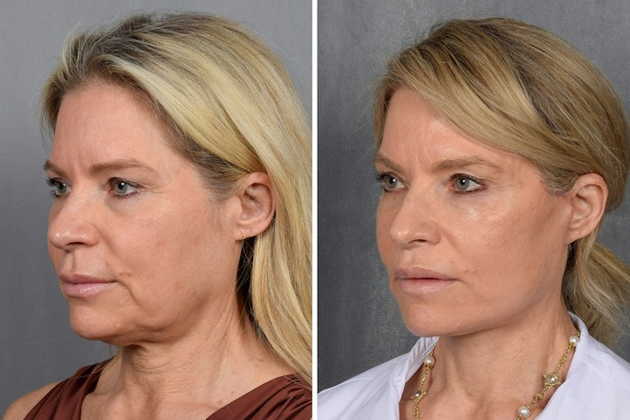 Facelift Before & After Gallery - Patient 110525 - Image 1