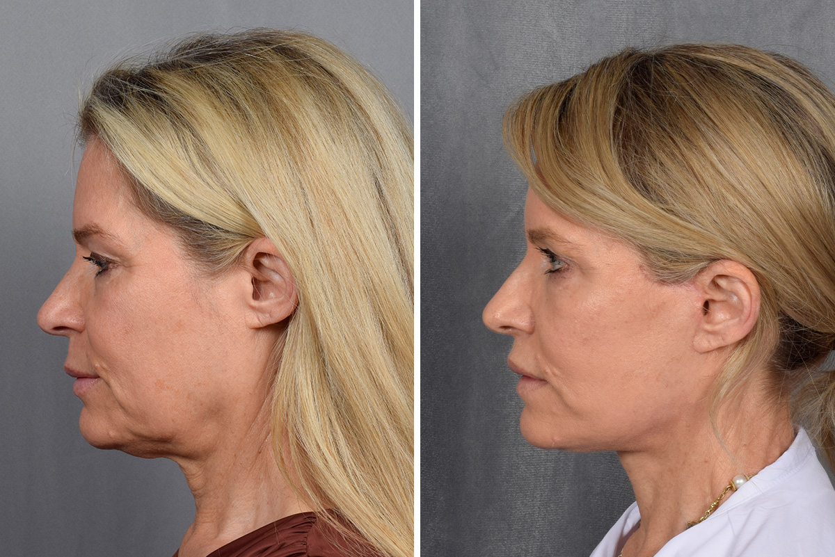 Facelift Before & After Gallery - Patient 110525 - Image 2