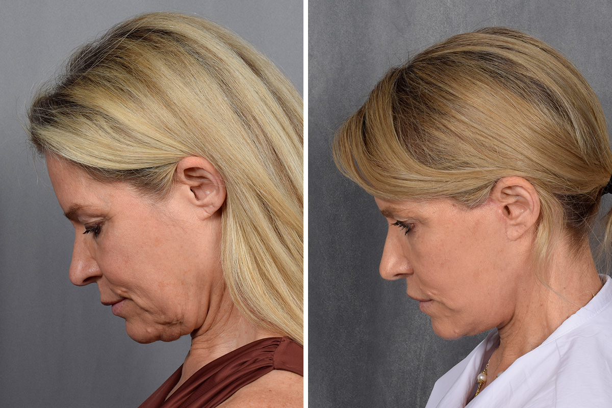 Facelift Before & After Gallery - Patient 110525 - Image 3