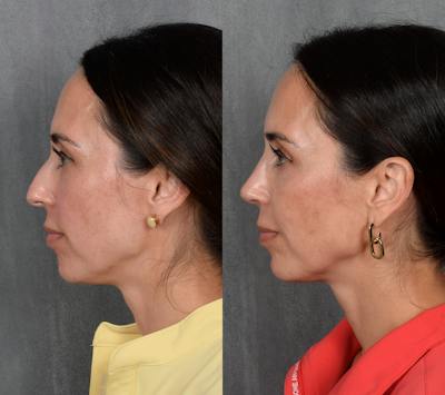 Rhinoplasty Before & After Gallery - Patient 249540 - Image 1