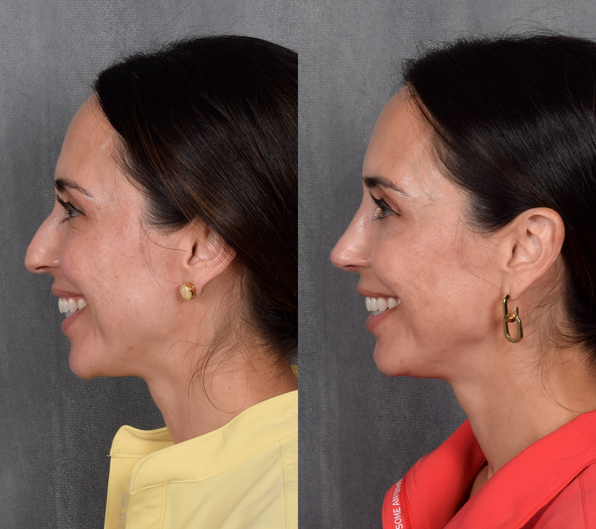 Rhinoplasty Before & After Gallery - Patient 249540 - Image 2
