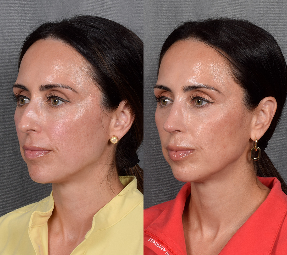 Rhinoplasty Before & After Gallery - Patient 249540 - Image 3