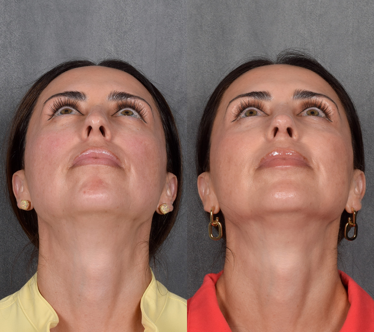 Rhinoplasty Before & After Gallery - Patient 249540 - Image 4