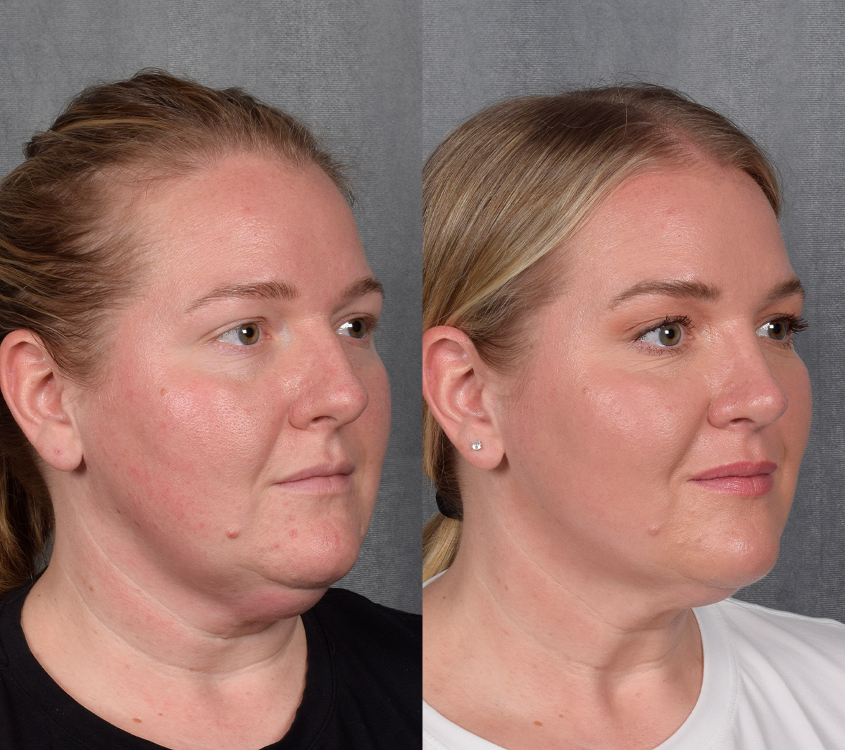 Rhinoplasty Before & After Gallery - Patient 257016 - Image 2