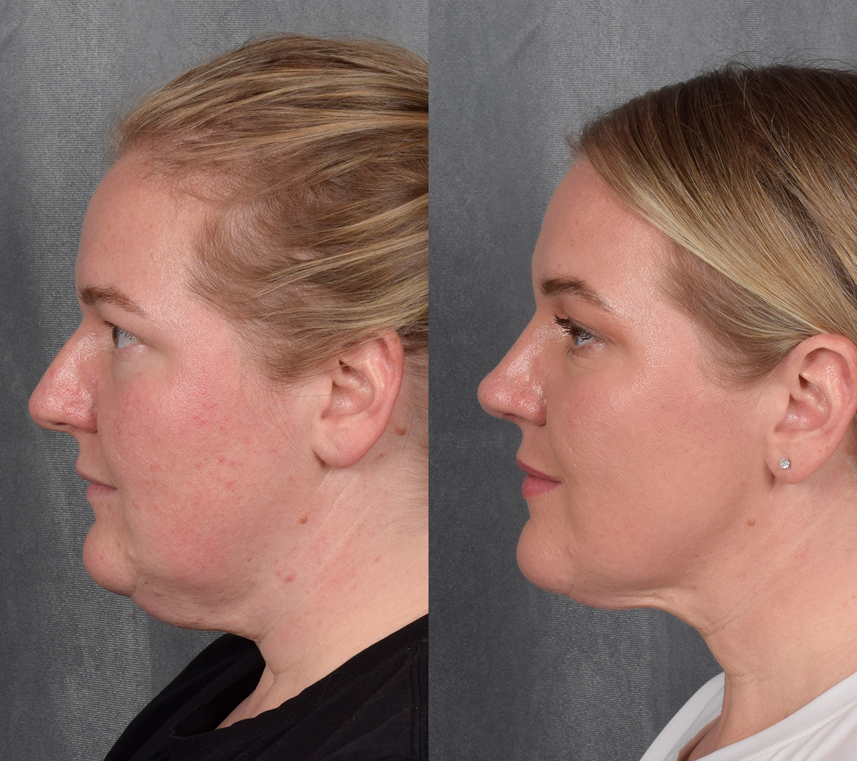 Rhinoplasty Before & After Gallery - Patient 257016 - Image 1
