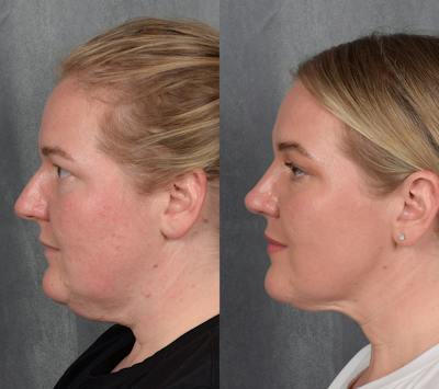 Rhinoplasty Before & After Gallery - Patient 257016 - Image 1