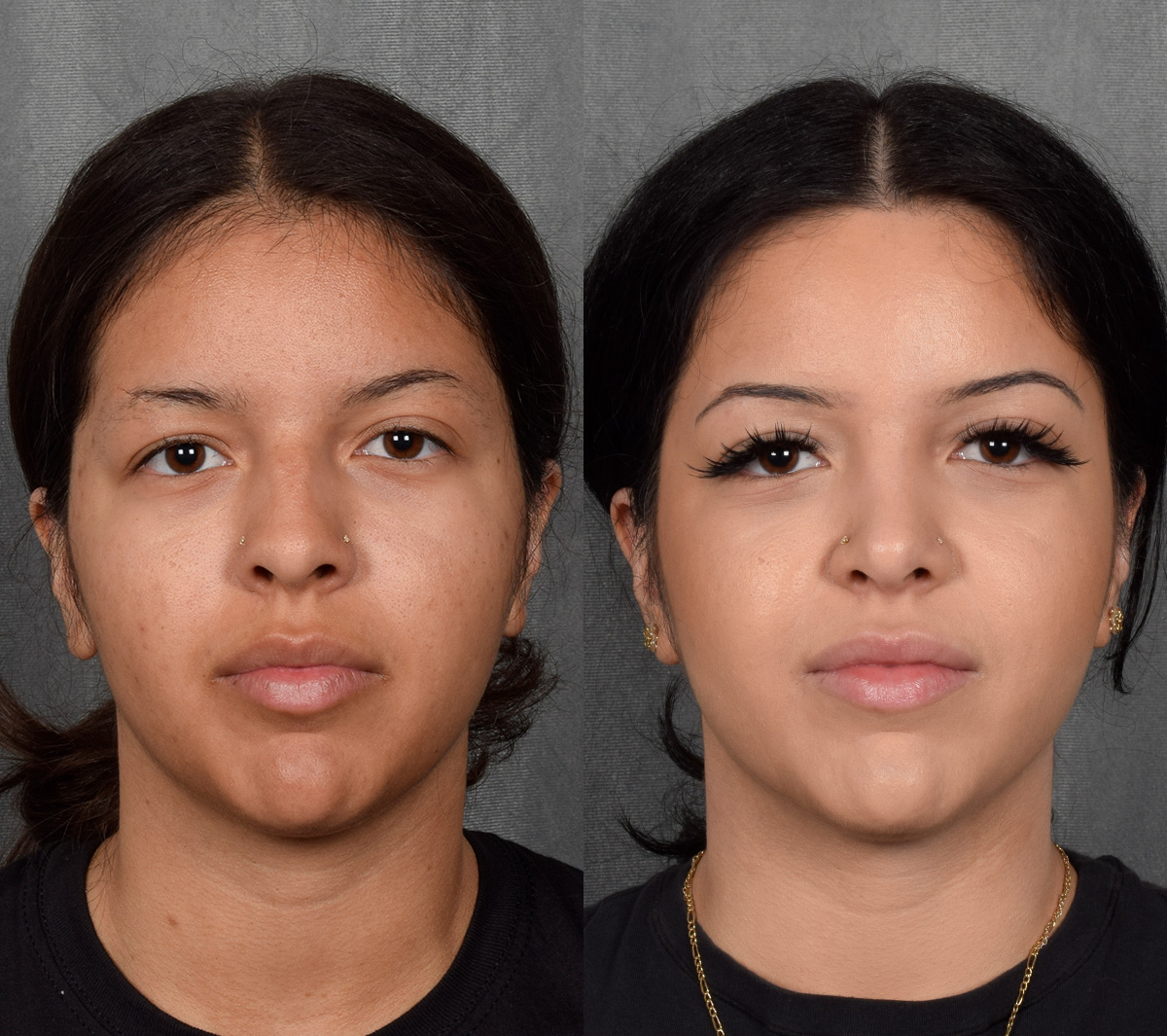 Rhinoplasty Before & After Gallery - Patient 114693 - Image 4