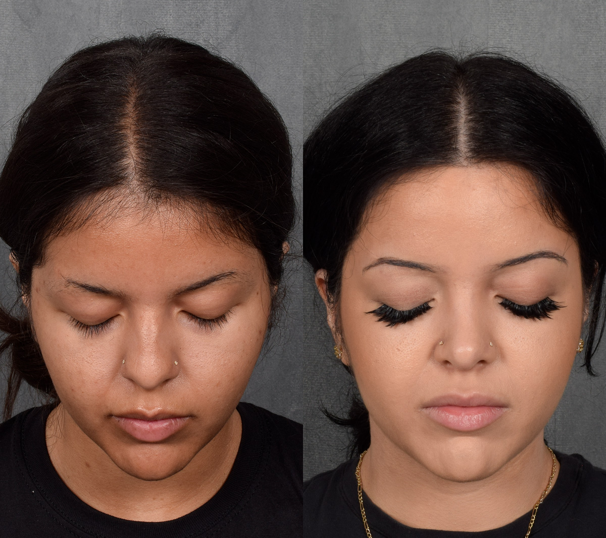 Rhinoplasty Before & After Gallery - Patient 114693 - Image 6