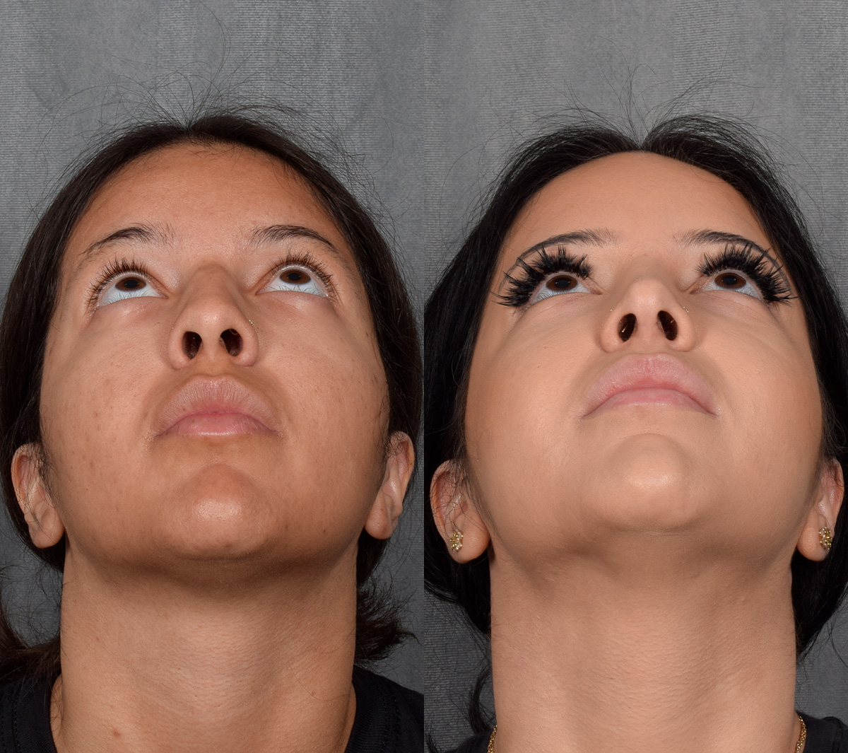 Rhinoplasty Before & After Gallery - Patient 114693 - Image 5