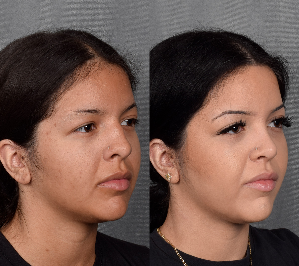 Rhinoplasty Before & After Gallery - Patient 114693 - Image 7
