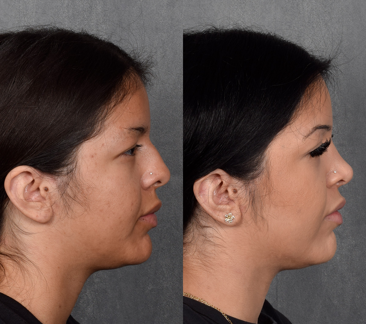 Rhinoplasty Before & After Gallery - Patient 114693 - Image 8