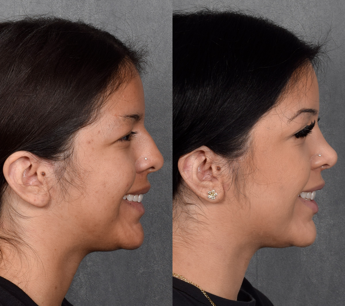 Rhinoplasty Before & After Gallery - Patient 114693 - Image 9