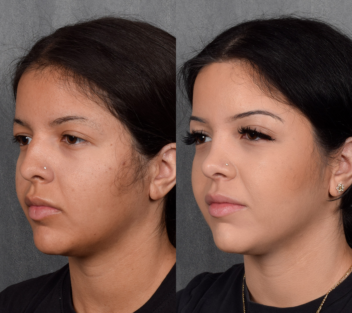 Rhinoplasty Before & After Gallery - Patient 114693 - Image 3
