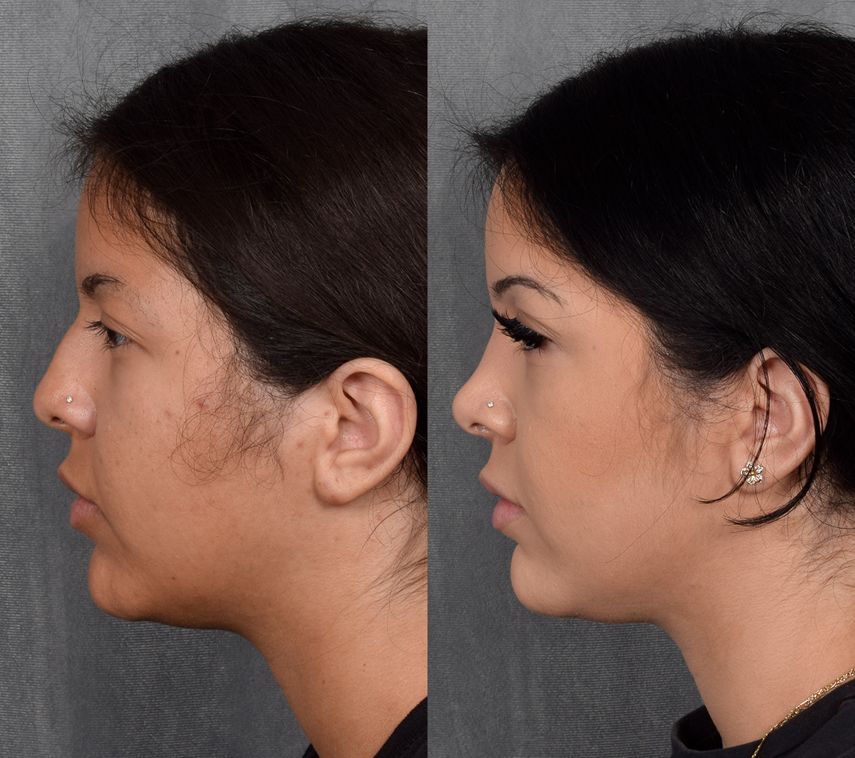 Rhinoplasty Before & After Gallery - Patient 114693 - Image 1