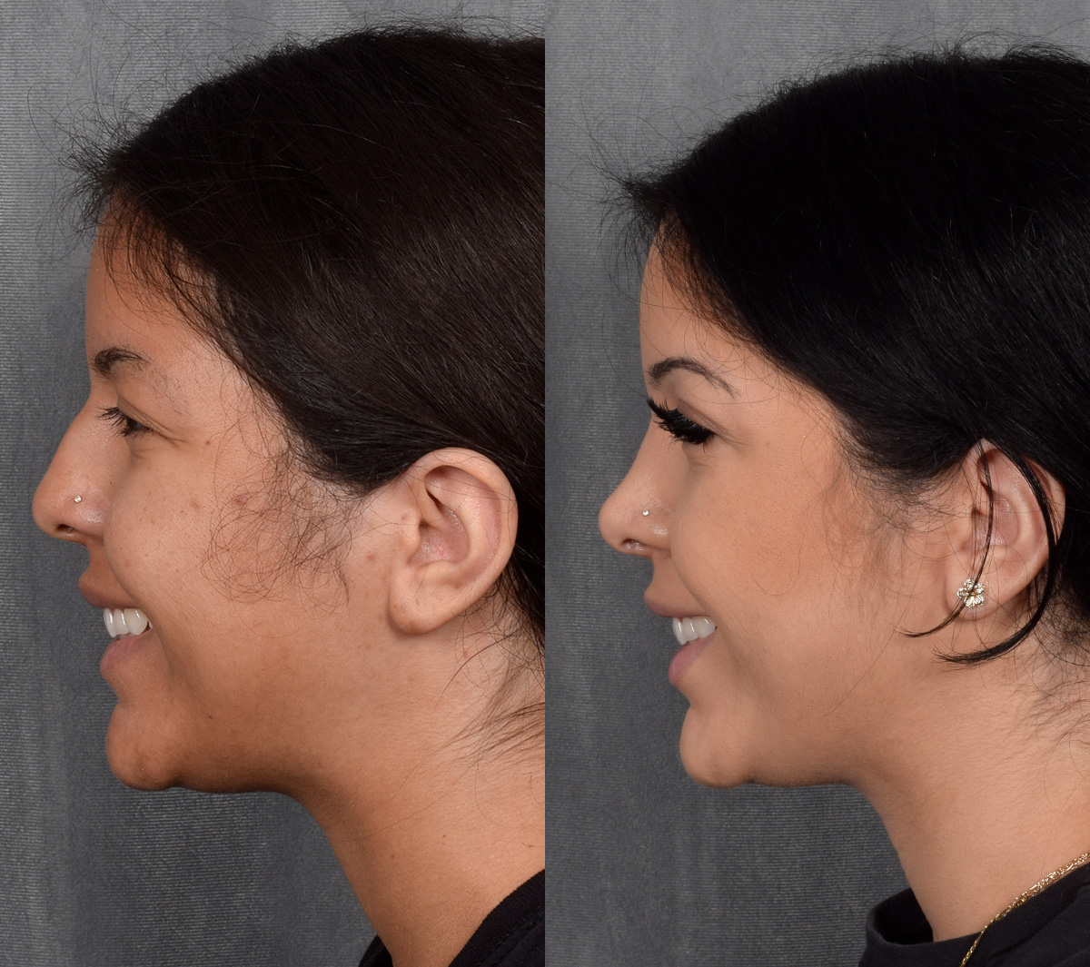 Rhinoplasty Before & After Gallery - Patient 114693 - Image 2