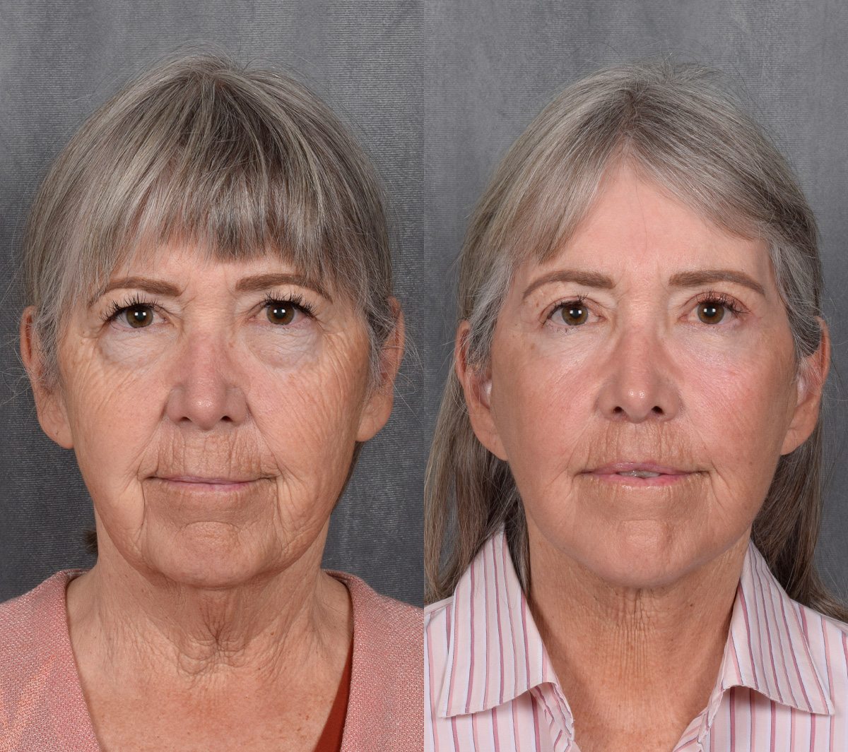 CO2 Laser Before & After Gallery - Patient 151635 - Image 1