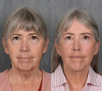 Neck Lift Before & After Gallery - Patient 112107 - Image 1