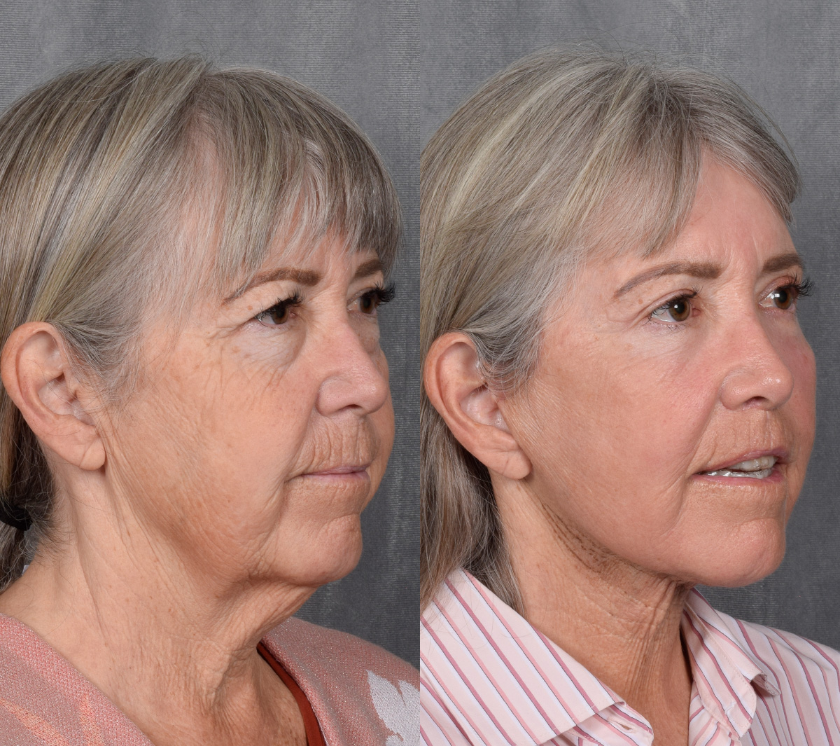 CO2 Laser Before & After Gallery - Patient 151635 - Image 4