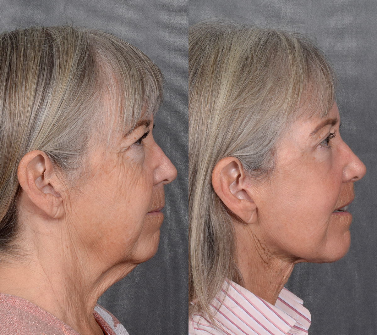 CO2 Laser Before & After Gallery - Patient 151635 - Image 5