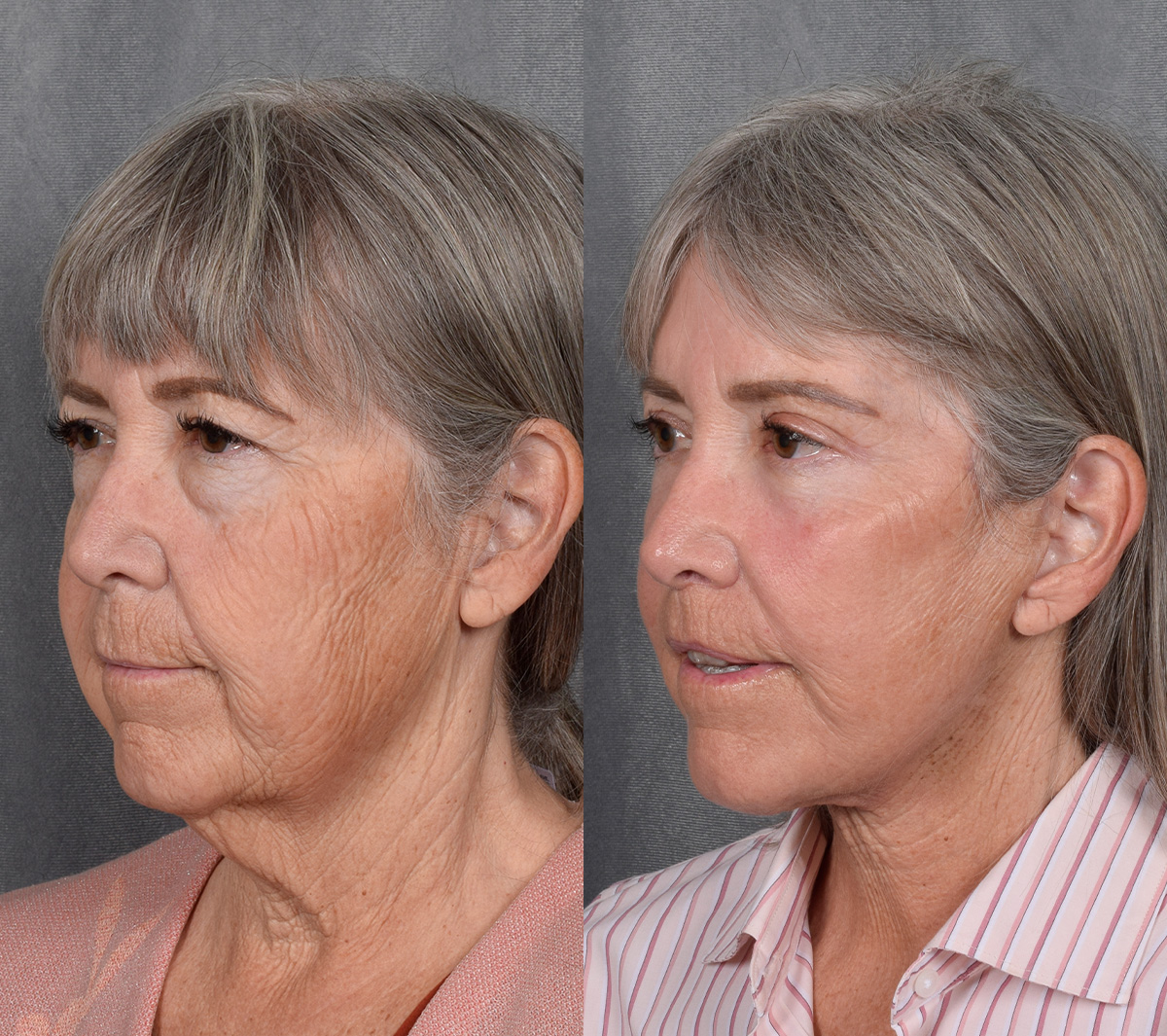 CO2 Laser Before & After Gallery - Patient 151635 - Image 2