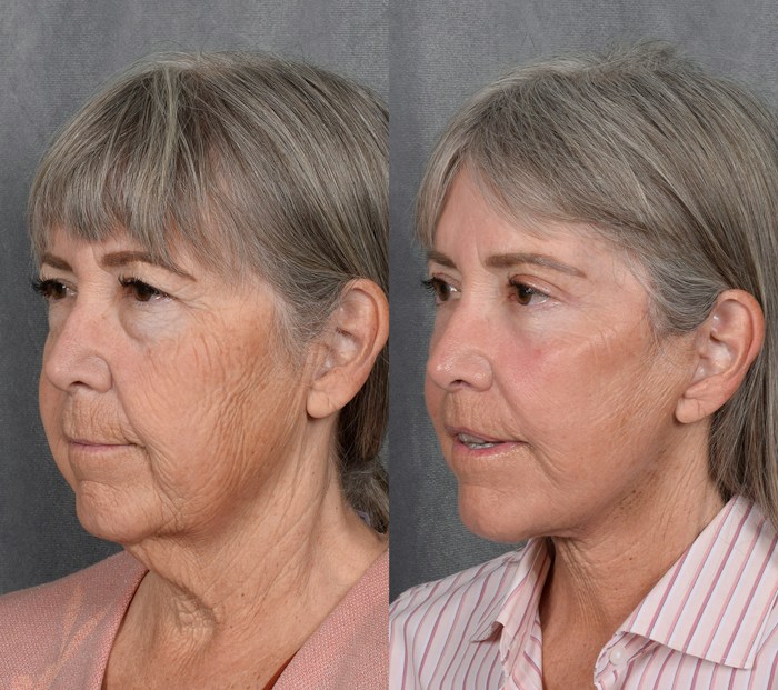 Facelift Before & After Gallery - Patient 371647 - Image 1