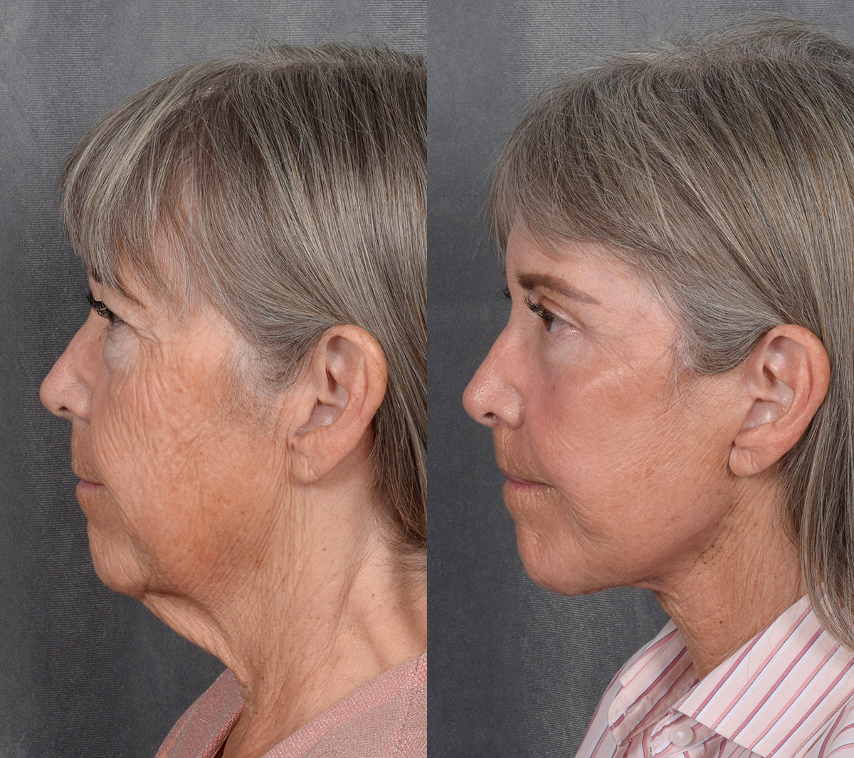CO2 Laser Before & After Gallery - Patient 151635 - Image 3