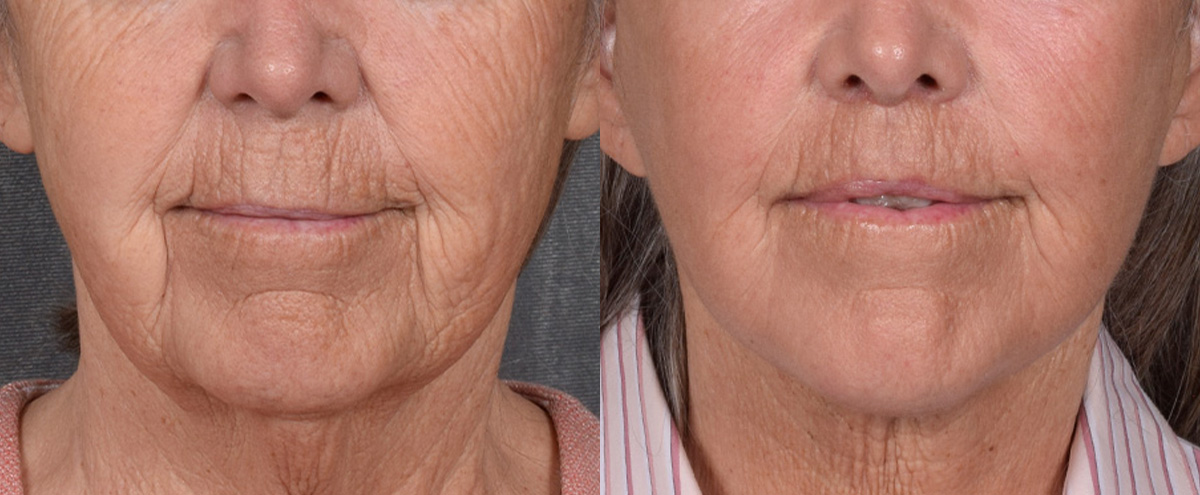 Lip Lift Before & After Gallery - Patient 347633 - Image 1