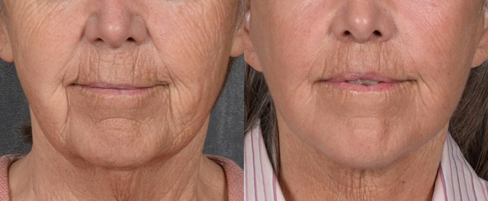 Lip Lift Before & After Gallery - Patient 347633 - Image 1