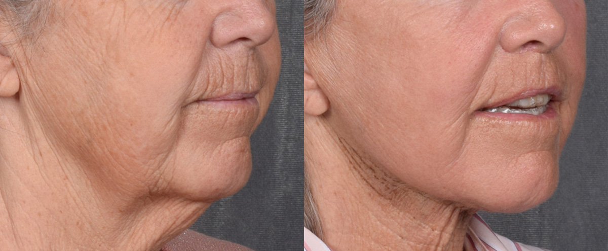 Lip Lift Before & After Gallery - Patient 347633 - Image 2