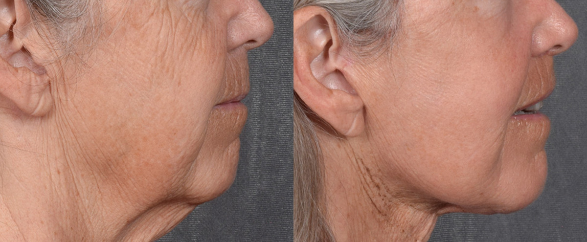 Lip Lift Before & After Gallery - Patient 347633 - Image 3