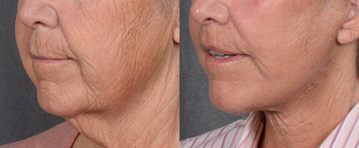 Lip Lift Before & After Gallery - Patient 347633 - Image 4