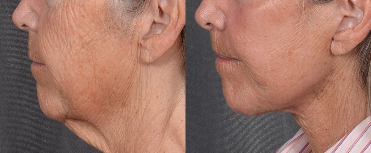 Lip Lift Before & After Gallery - Patient 347633 - Image 5