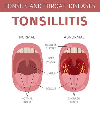 tonsillitis graphic