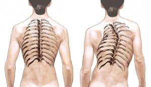 Normal spine (left) – Scoliosis (right)