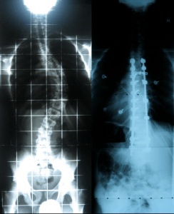 A 16-year-old male diagnosed with adolescent idiopathic scoliosis, treated with a posterior approach utilizing pedicle screws and rods.