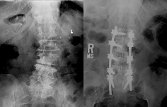 A 71 year old female was diagnosed with degenerative scoliosis. Treated with minimally-invasive scoliosis correction.