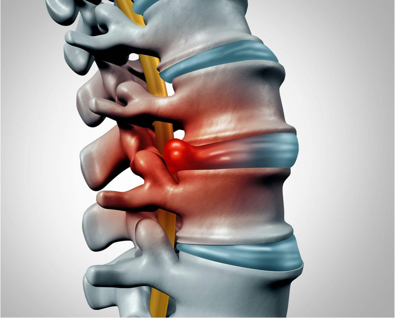 Herniated Disc