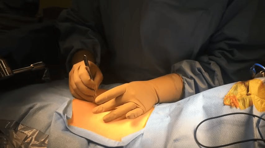 Minimally Invasive Microdiscectomy L5-S1 video