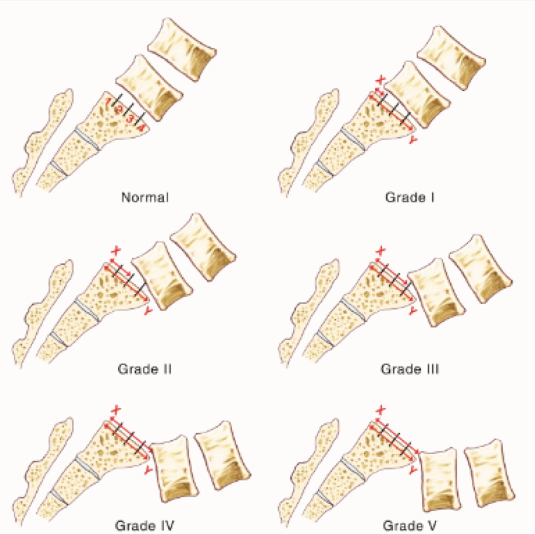 Spondylolisthesis Surgery
