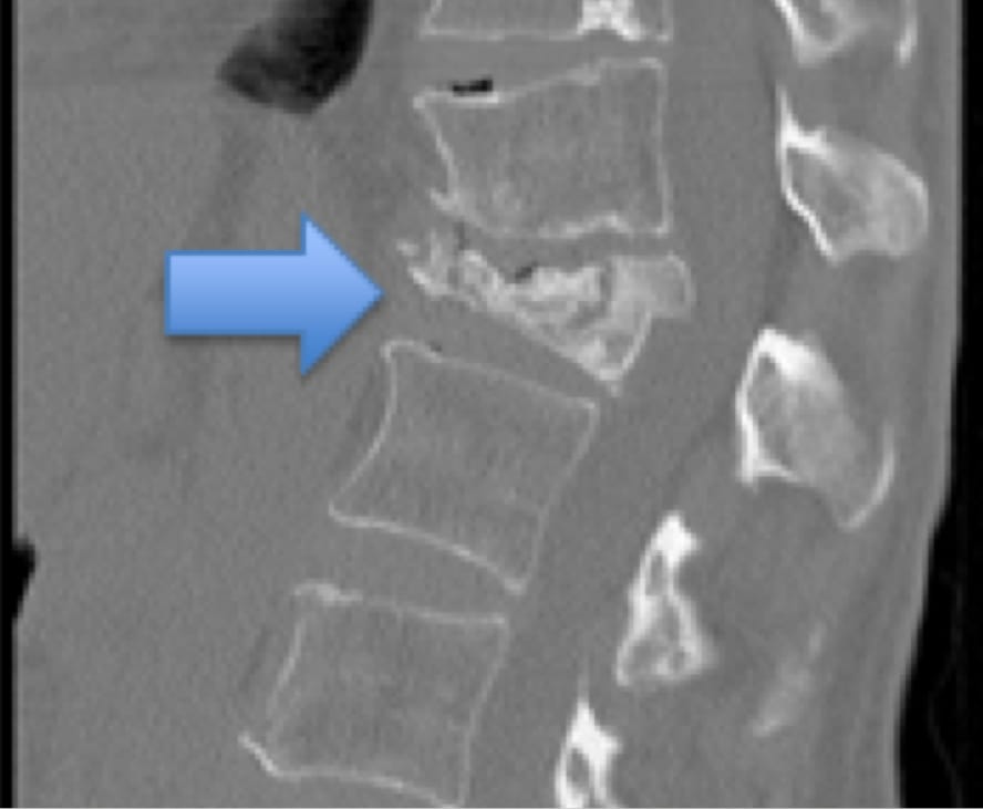 CT Scan demonstrating L1 Compression Fracture