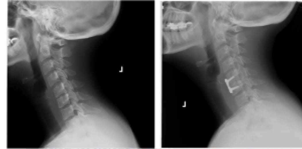 Pre and post operative x-rays of a 49 year old female who was treated with an ACDF