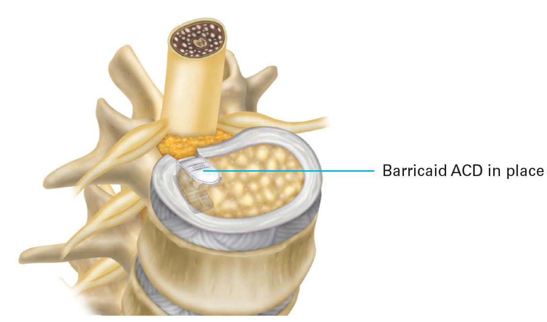 Barricaid Annular Closure Device