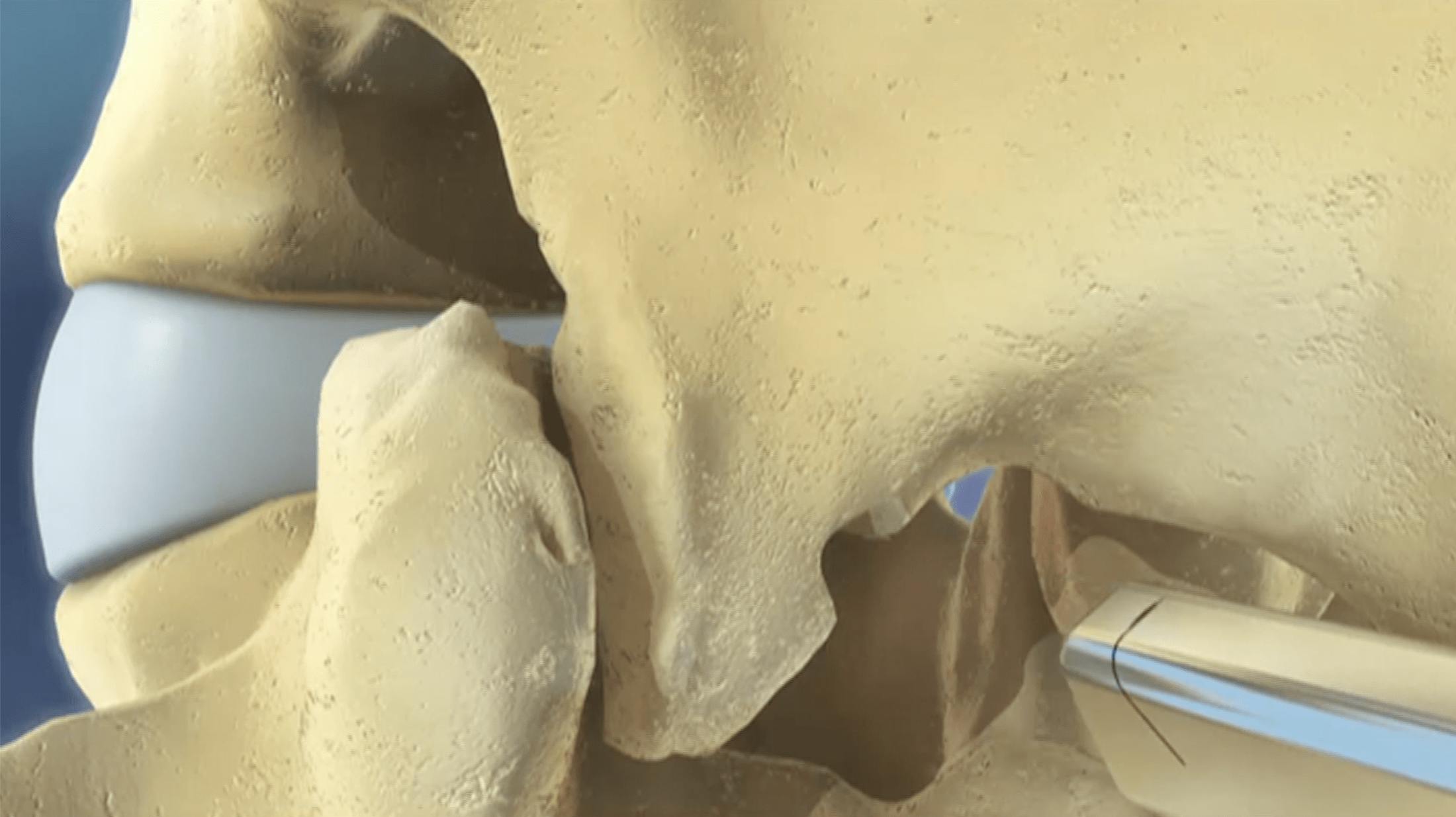 Barricaid Annular Closure Device video