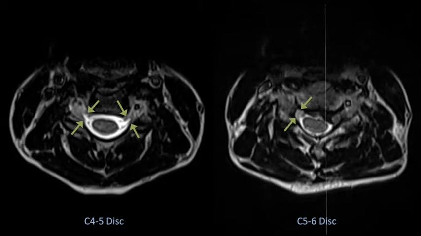 Cervical Disc Replacement with Mobi-C for Treatment of Cervical Disc Herniation