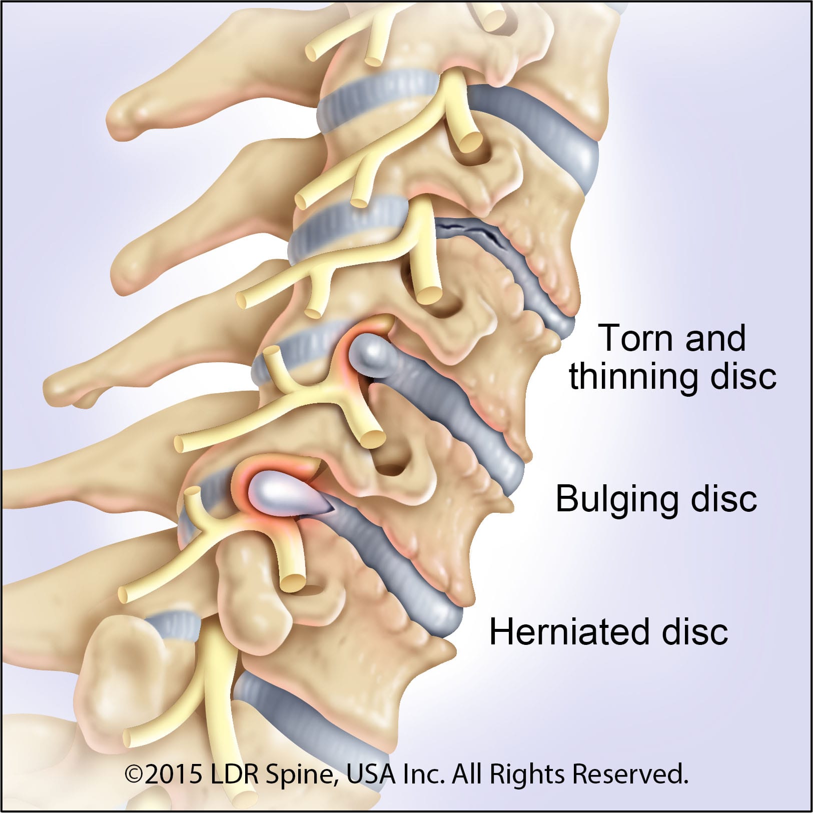 Simplify Cervical Disc infographic