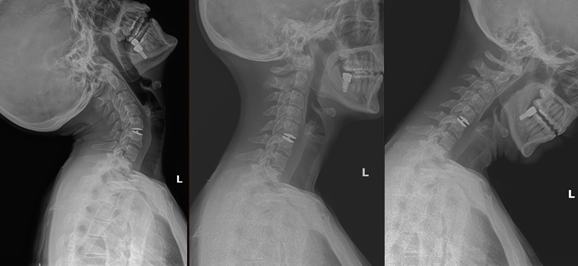Post-operative X-rays Showing Motion Preservation