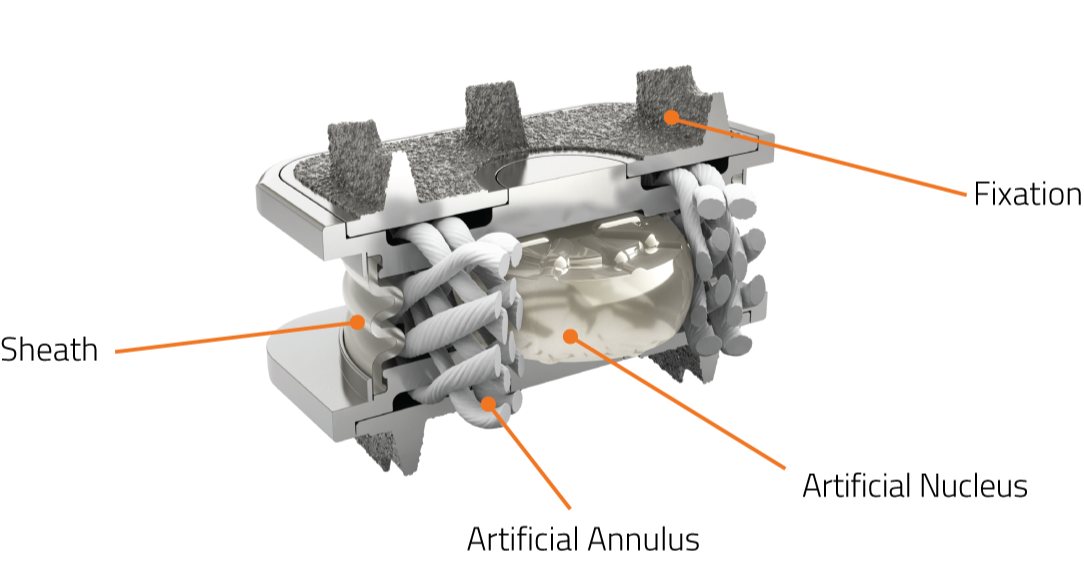 Orthofix M6-C Artificial Cervical Disc
