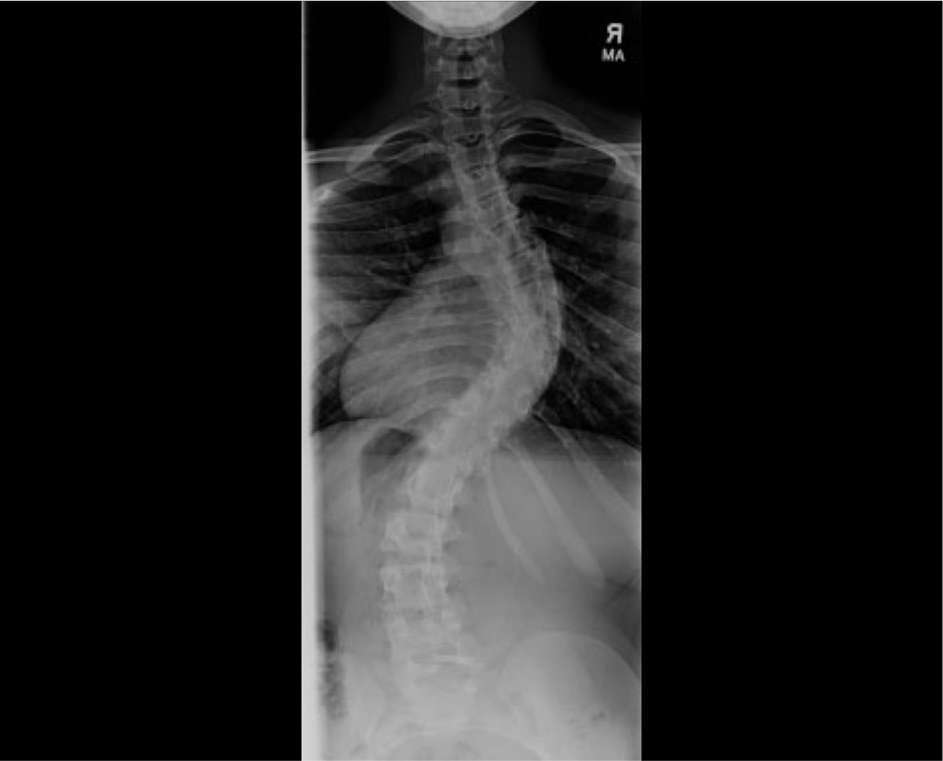 Adolescent Idiopathic Scoliosis case study
